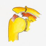rotator cuff tear