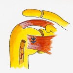 tenotomy