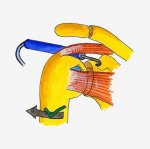 Arthrolysis