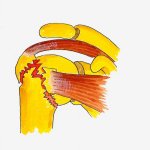 Promimal Humerus fracture