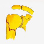 Fracture of the Humerus