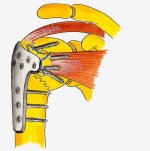 Internal Fixation