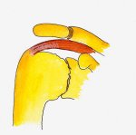 Osteo arthritis
