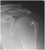 rotator cuff repair