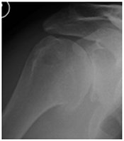 Arthritis of the shoulder
