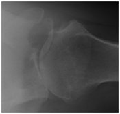 shoulder arthritis