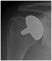 Shoulder replacement