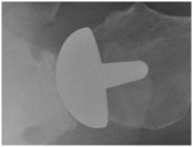 shoulder replacement