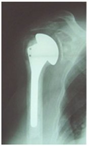 Stemmed shoulder replacement