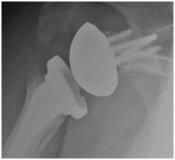reverse shoulder replacement