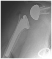 shoulder